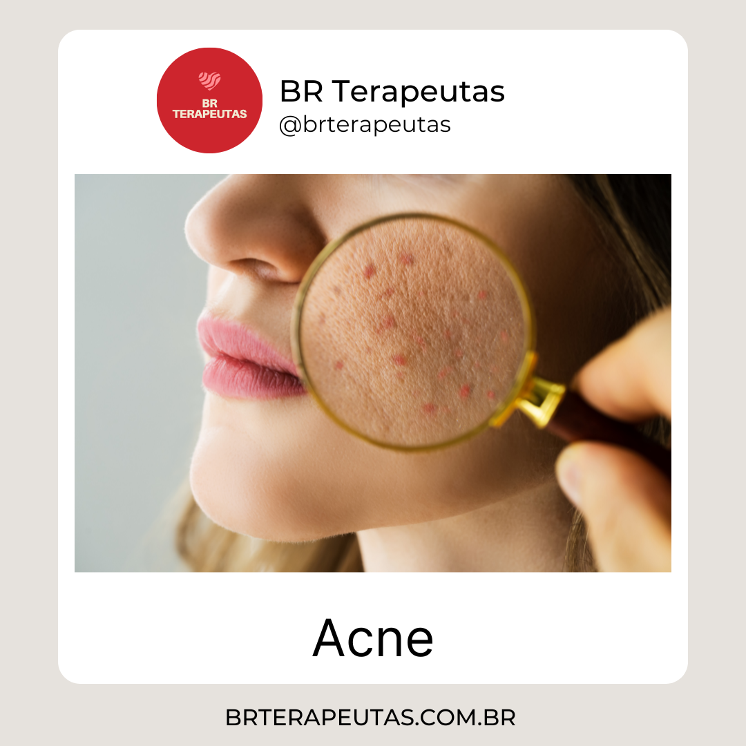 O que é a Acne?