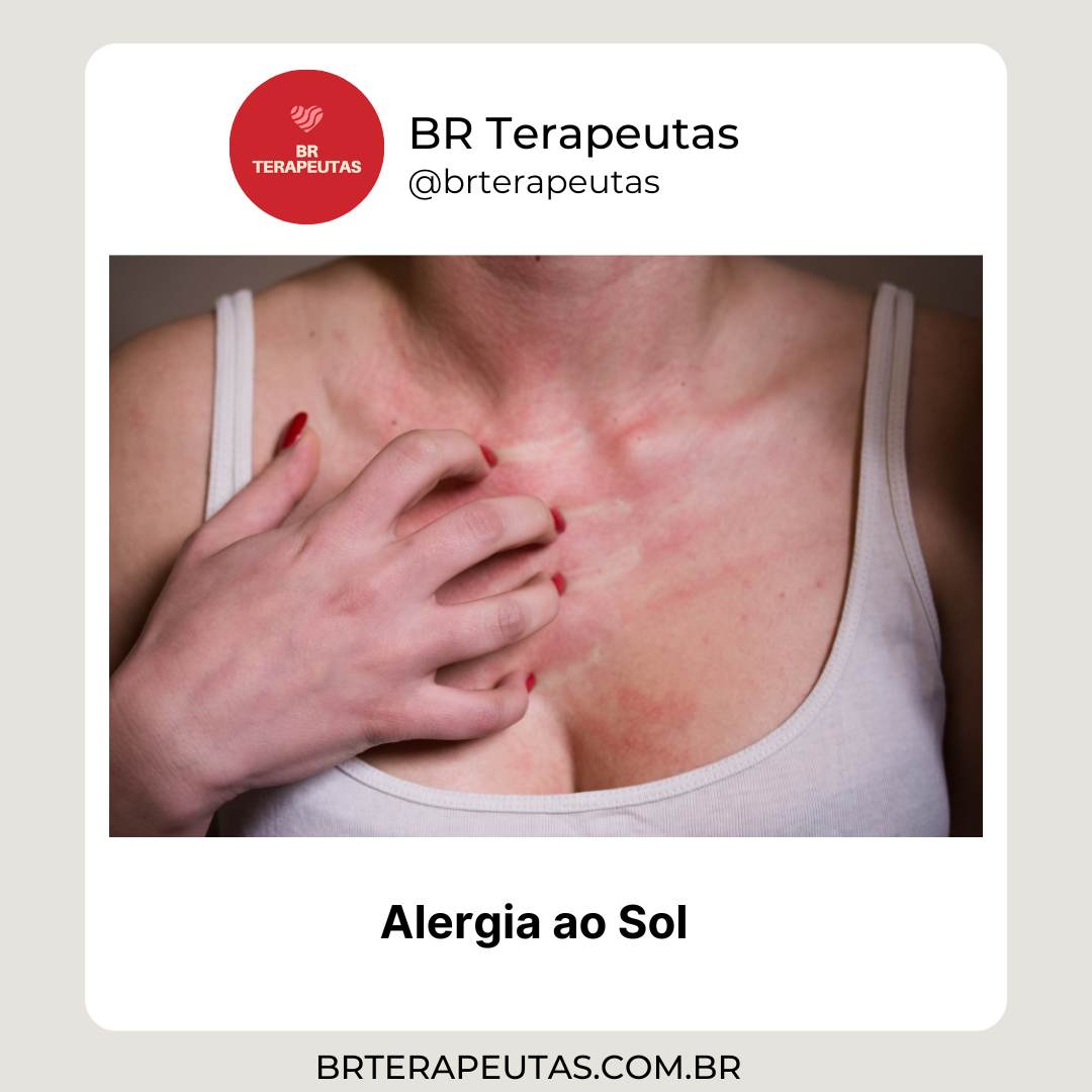 Alergia ao sol - foto de uma mulher com alergia - BR Terapeutas