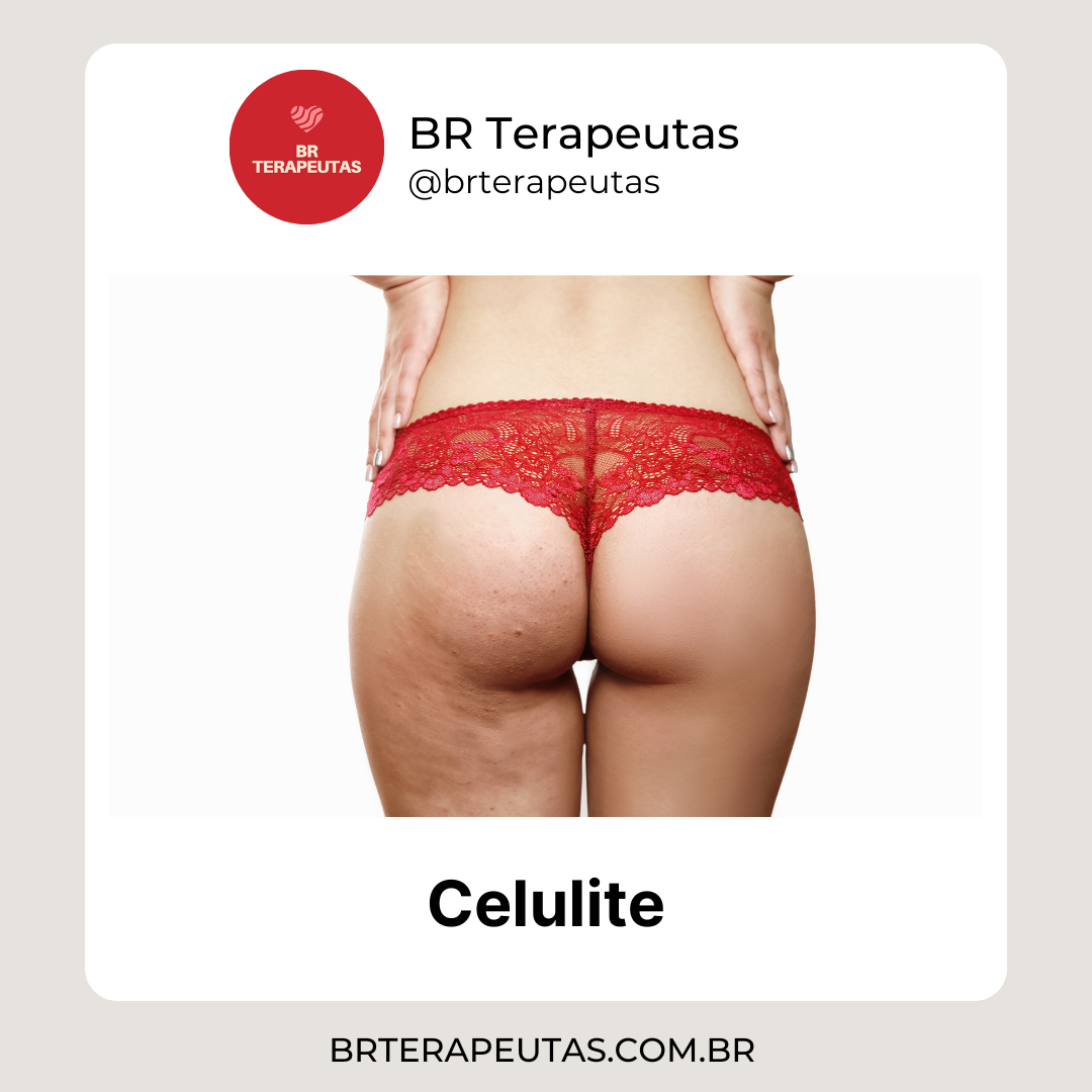 O que é Celulite | BR Terapeutas