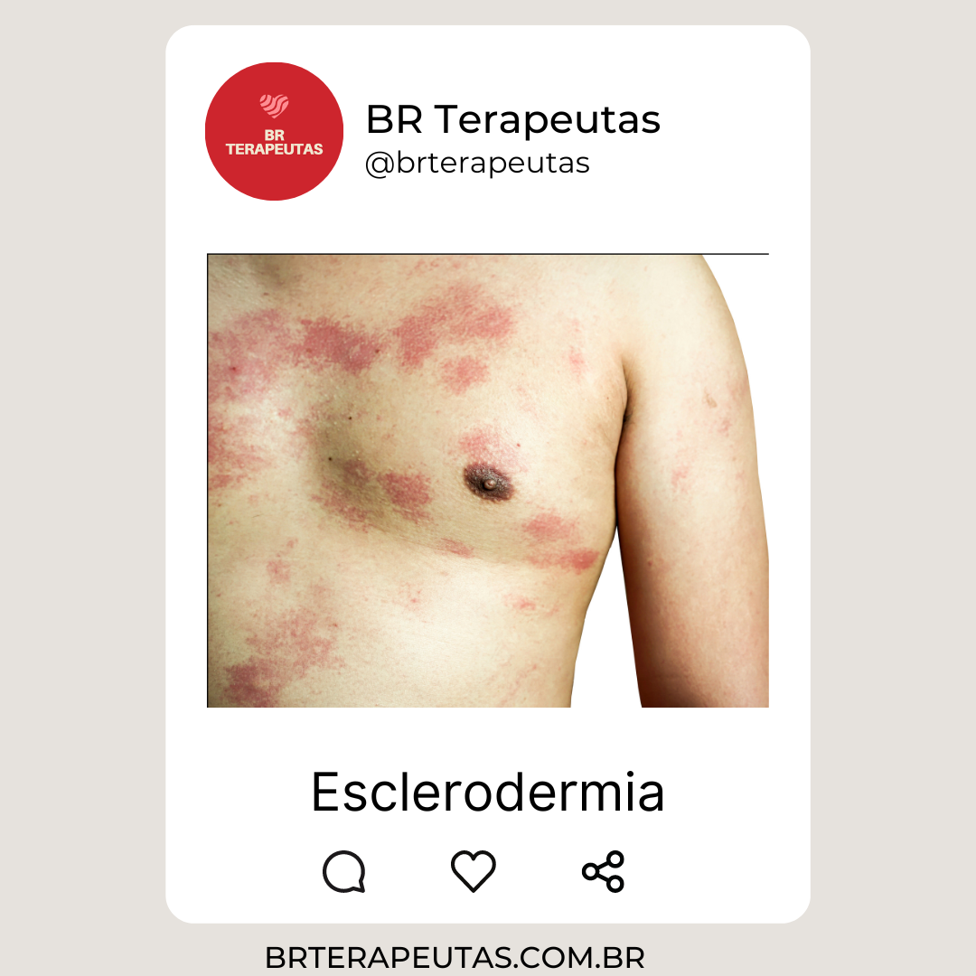 O que é esclerodermia