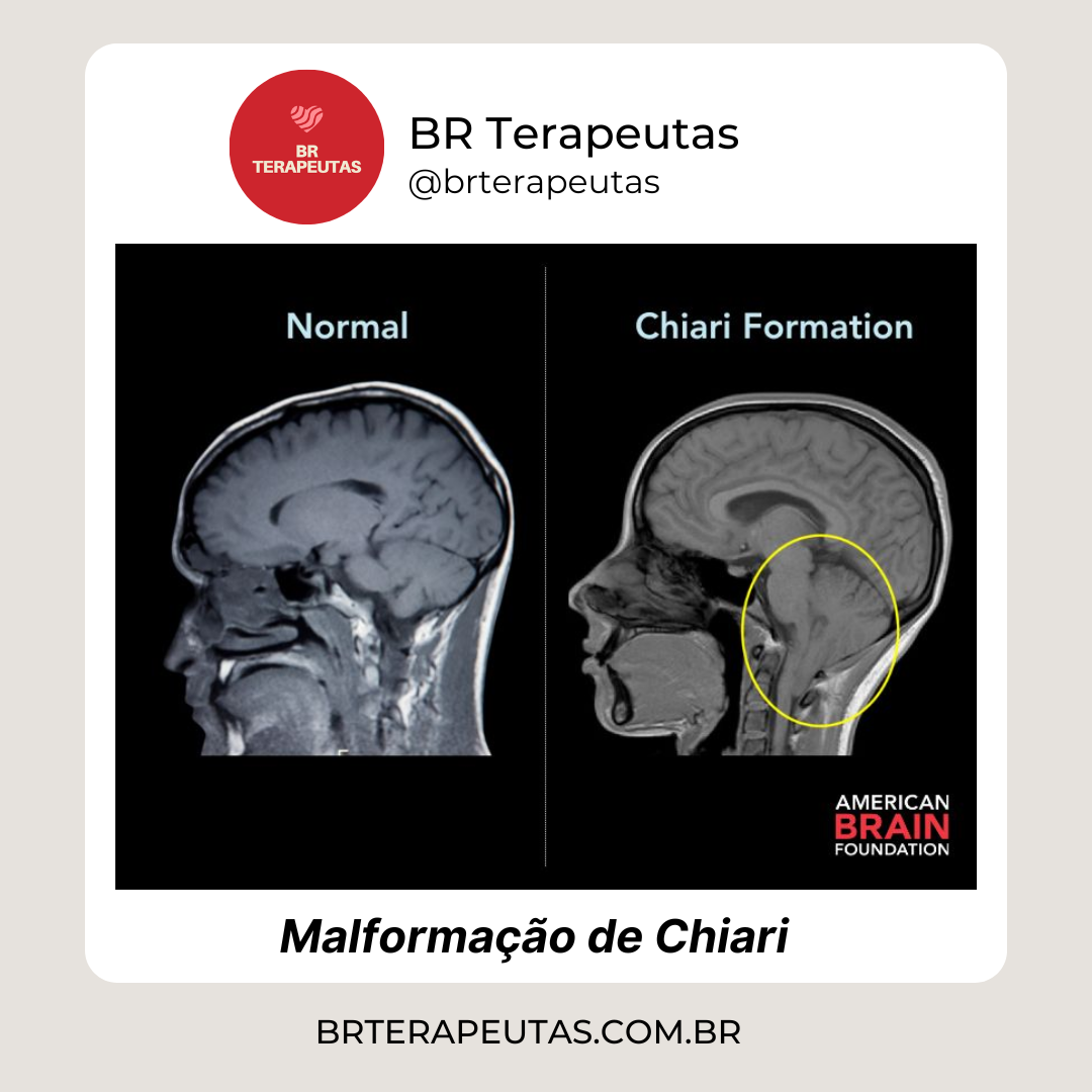  Malformação de Chiari - Foto de um cérebro com a malformação