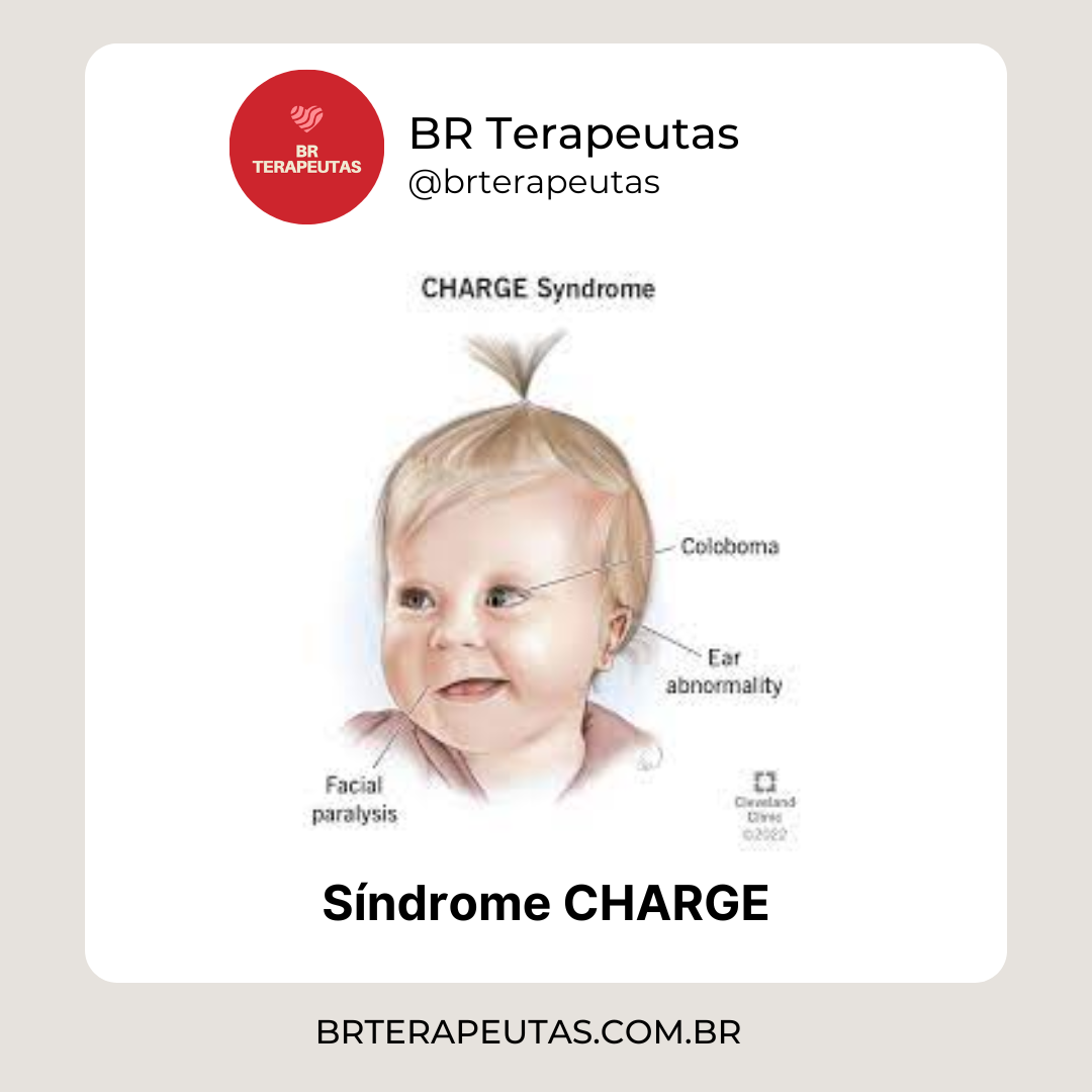 Síndrome CHARGE - foto de uma criança com síndrome CHARGE Mayo clinic - BR Terapeutas