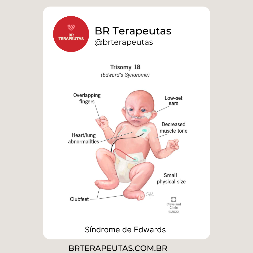 O que é a Síndrome de Edwards (Trissomia 18) - foto de um bebê com a síndrome de edwards
