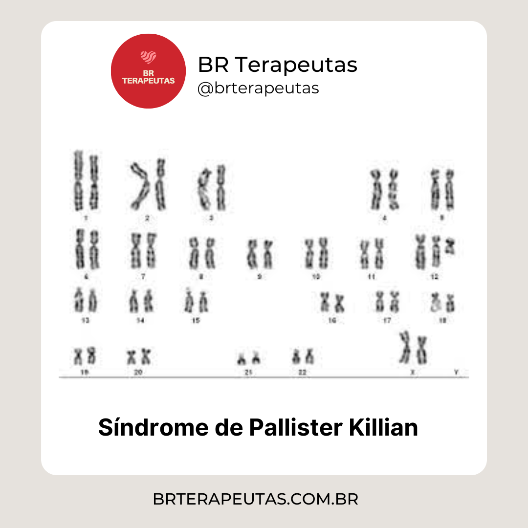 O que é a Síndrome de Pallister Killian - foto da síndrome de Pallister-Killian com 47 cromossomos - BR Terapeutas