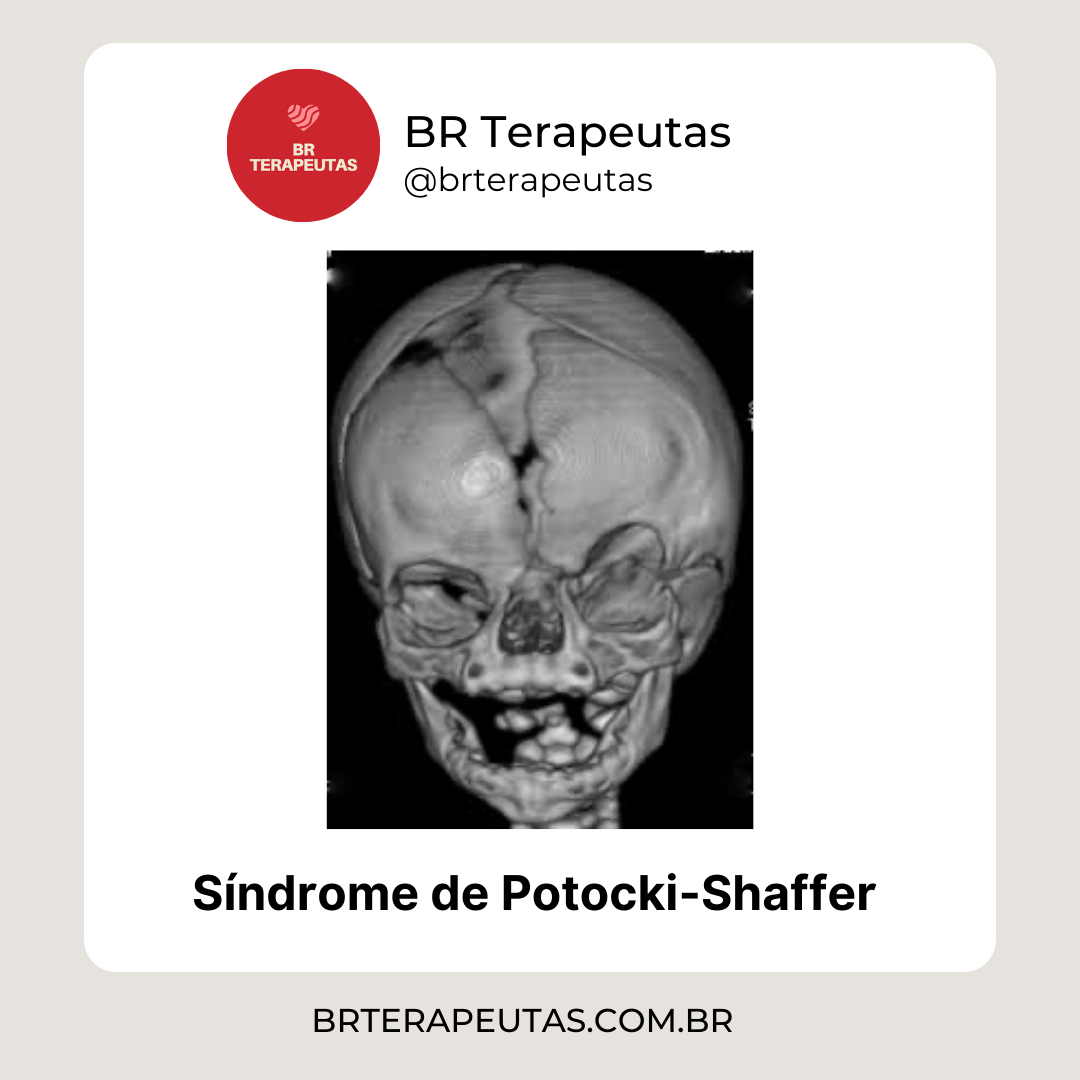 Informações sobre a Síndrome de Potocki-Shaffer - foto de um crânio ampliado - BR Terapeutas