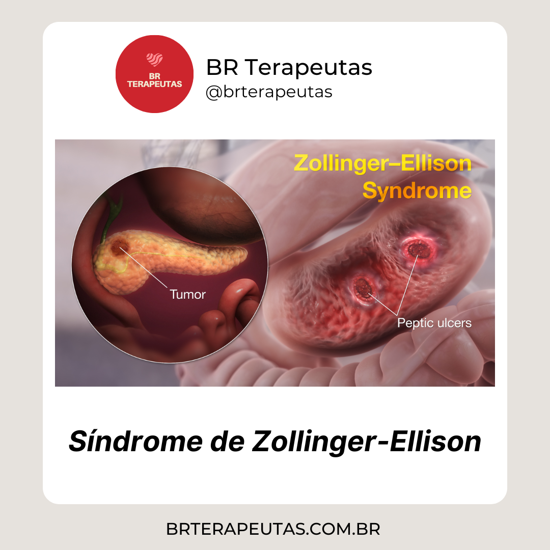 Causa e tratamento da Síndrome de Zollinger-Ellison - foto do sistema digestivo com a síndrome